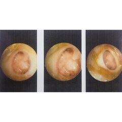 Ear endoscopy. Chronic suppurative otitis media (CSOM). Subtotal perforation of the tympanic...