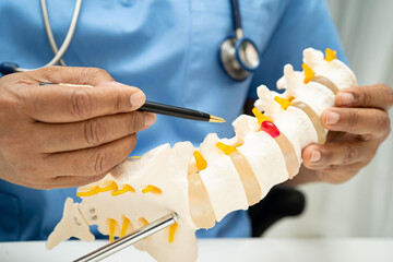 Asian doctor holding spinal nerve and bone model, Lumbar spine displaced herniated disc fragment...