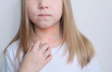 The child scratches atopic skin. Dermatitis, diathesis, allergy on the child's face.	