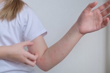The child scratches atopic skin. Dermatitis, diathesis, allergy on the child's body.	