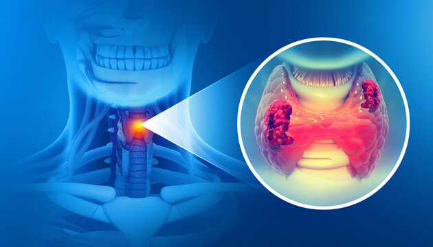 Thyroid gland cancer. showing thyroid gland with tumor. 3d illustration