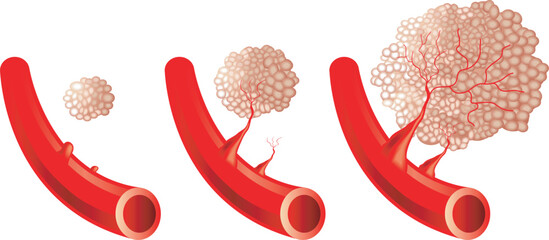 Medical illustration of angiogenesis progression.