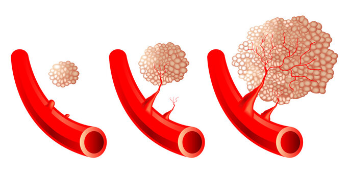 Medical illustration of angiogenesis progression.