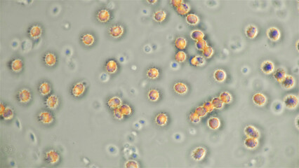Blood human under a microscope, erythrocytes - echinocytes in the blood that changed shape and they...