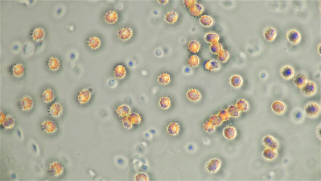 Blood human under a microscope, erythrocytes - echinocytes in the blood that changed shape and they appeared spikes (spicules), triangular outgrowths of the same size. Inverted colors