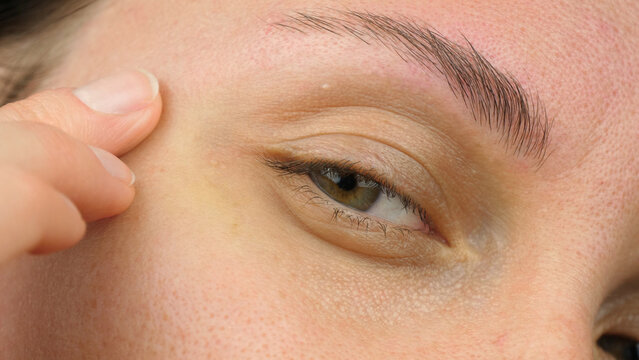 Close-up of the eye area. Eyelid. Oily skin, milia, and papule around the eyes.