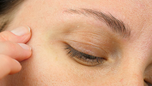 skin problem solution. before treatment. Close-up of the eye area. eyelid. eyelid skin problem.