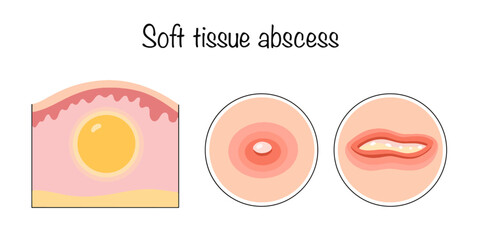 Soft tissue abscess