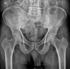 X-ray pelvis and hip joint 
