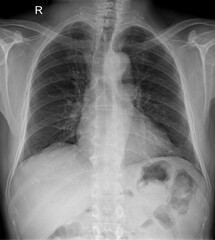 Examining the Heart of High-Resolution Chest X-Rays