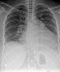 Diagnostic PA Chest X-ray: Comprehensive Assessment of Thoracic Health and Respiratory Conditions


