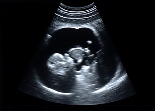 The obstetric ultrasound exam of pregnant woman shows a fetus with 361 days of gestation age already.