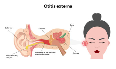 Obraz premium Otitis externa anatomy ear disease inflammation 