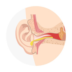 Otitis externa anatomy ear disease inflammation 
