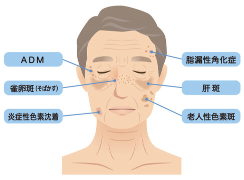 高齢男性の顔　シミ　名称　美容　老化