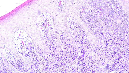 Photomicrograph showing histology of a perianal tumor sample + B20 with results of condyloma accuminata + pyogenic granuloma in the anatomical pathology laboratory
