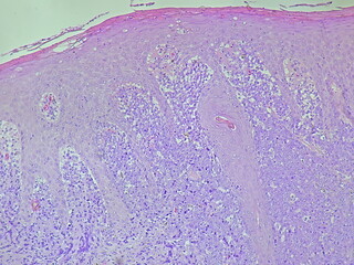 Photomicrograph showing histology of a perianal tumor sample + B20 with results of condyloma...