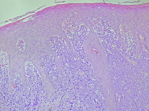 Photomicrograph showing histology of a perianal tumor sample + B20 with results of condyloma accuminata + pyogenic granuloma in the anatomical pathology laboratory