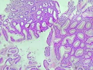 Human cell tissue under microscope in pathology laboratory. Microscopic picture of chronic gastric...