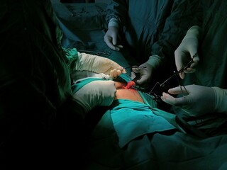 Appendix specimen from appendectomy, after surgery from the doctor.
