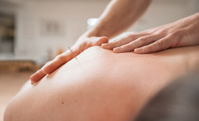 Fototapeta premium Therapist's hands gently massage patient's back during thin needles acupuncture treatment. Image highlights relaxation, alternative medicine healthcare practices in clinic. Health and bodycare concept