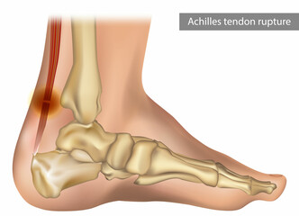 Achilles tendon rupture. Achilles injury