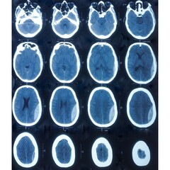Computer tomography (CT scan) showed subdural hematoma in trauma patient.