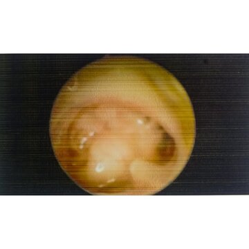 Ear endoscopy. Chronic suppurative otitis media (CSOM). Subtotal perforation of the tympanic membrane.