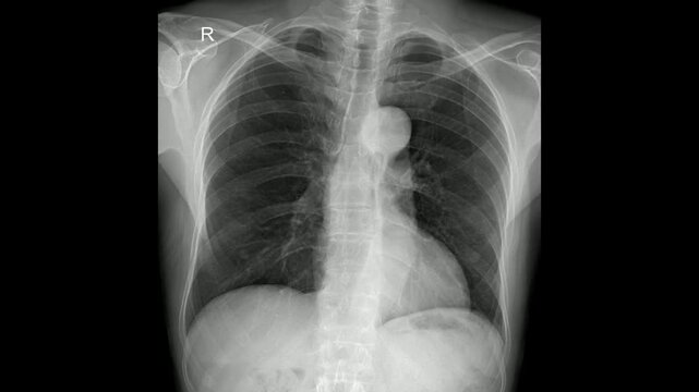 Chest PA X-Ray for Respiratory and Heart Health Evaluation