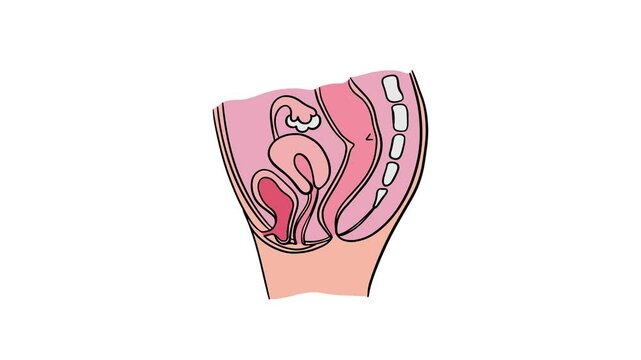 PROLAPSED BLADDER Of Women Animated Medical Education Scheme For Students Of University