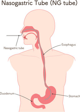 胃ドレナージ、Nasogastric tube