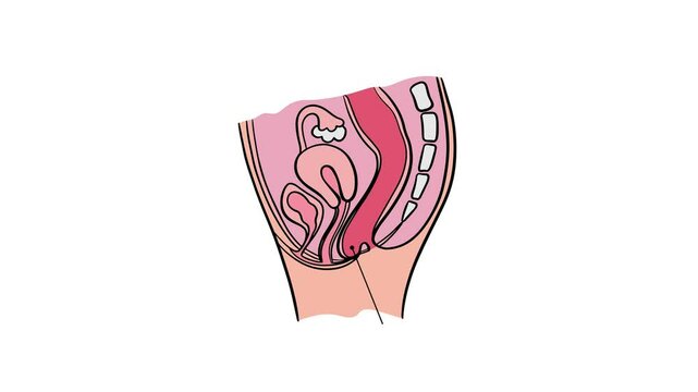 PROLAPSED RECTUM Of Women Animated Medical Education Scheme For Students Of University 