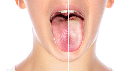 Child man tongue with a white plaque. Comparison of a diseased tongue with a white plaque and a...