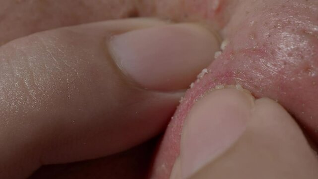 Squeezing pimples on the nose with hands. Pushing and squeezing to release the clogged acne sebum. Close up skin pore clogged acne sebum. Many clogged acne released on the nose. Skin problem concept.