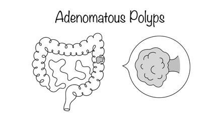 Adenomatous Polyps