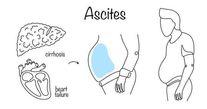 Ascites