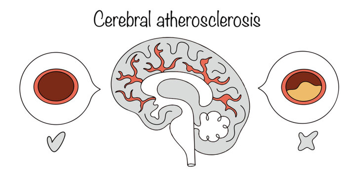 Cerebral atherosclerosis