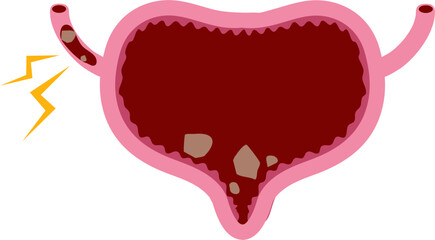 Bladder disease illustration. Urinary tract infection. Bladder cancer. Bladder stones. Bladder inconvenience.