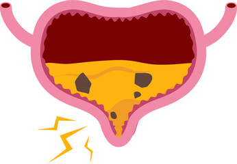Bladder disease illustration. Urinary tract infection. Bladder cancer. Bladder stones. Bladder inconvenience.