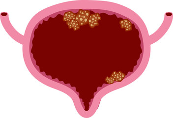 Bladder disease illustration. Urinary tract infection. Bladder cancer. Bladder stones. Bladder inconvenience.