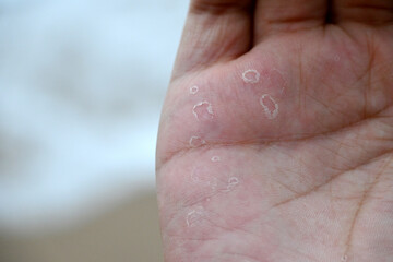 Close-up of a hand showing skin condition resembling small bubbles.