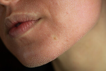 Close-up of skin after laser resurfacing – CO2 fractionated laser.
