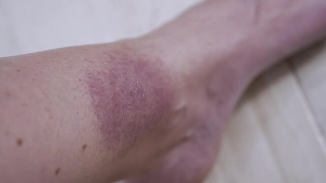 Close up, Formation of a Large Red Spot on the Skin from a Tick Bite. Irritation, itching, swelling, infection, redness around skin of leg. Lyme disease. Insect, mosquito, encephalitis tick bite.