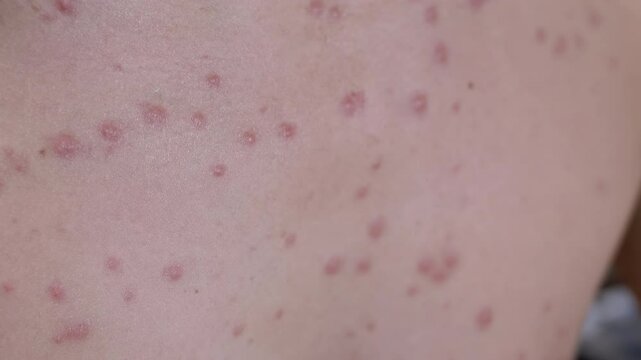Detailed view of chickenpox rash on a person's chest. Red spots and blisters, some crusted. Healthcare, dermatology, contagious disease concept.