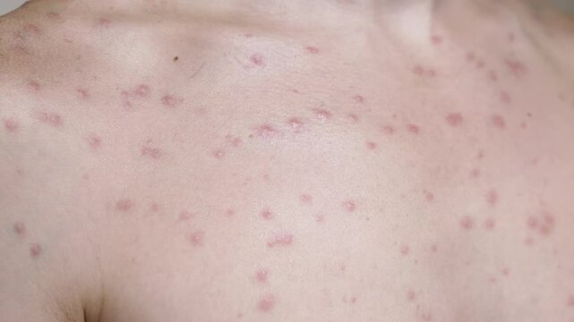 Close-up of chickenpox blisters on human skin. The rash covers the chest and neck areas, indicating a contagious viral infection. This visual represents the discomfort and health challenges of