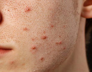 Fototapeta premium Acne, black spots and scars on the face