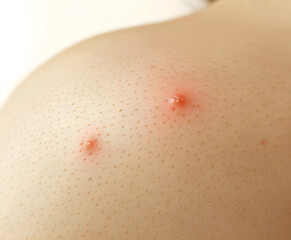 Furuncle or staphylococcal skin infection