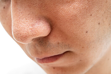 いちご鼻のクローズアップ：30代男性の毛穴と角栓