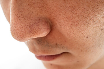 いちご鼻のクローズアップ：30代男性の毛穴と角栓