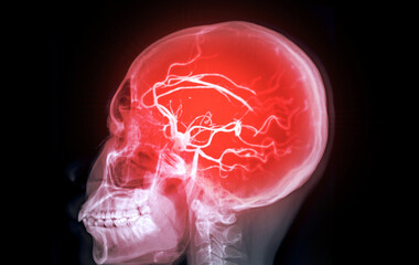 The contrast-enhanced CT Angiography (CTA) of the brain and neck, highlighting the cerebral blood...